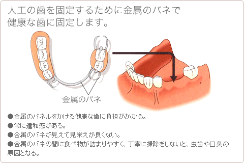 人工の歯を固定するために金属のバネで健康な歯に固定します。