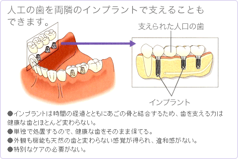 人工の歯を両隣のインプラントで支えることもできます。
